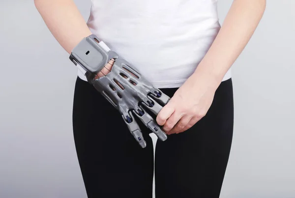 Uma menina com uma prótese impressa em uma impressora 3D segura os dedos da prótese com a mão . — Fotografia de Stock