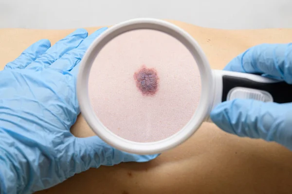 Examination of a mole on the patient\'s body. The concept of studying moles to prevent the development of skin cancer or melanoma.