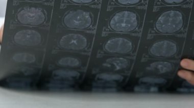 Beyin tomografisi ve beyin sarsıntısı geçiren yaşlı kadın doktor, tedavi edilemez tümör.