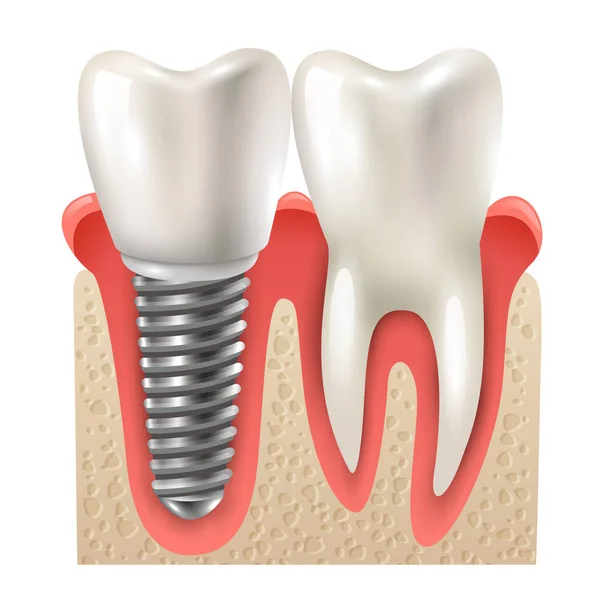 Modelo de primer plano del conjunto de dientes de implante dental — Vector de stock