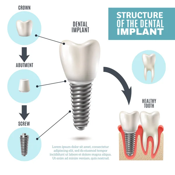 Dental Implant Structure Medical Infographic Poster — Stock Vector