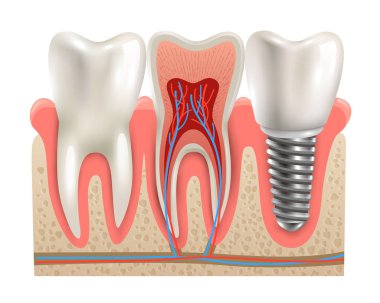 Diş implantları anatomi Closeup modeli 