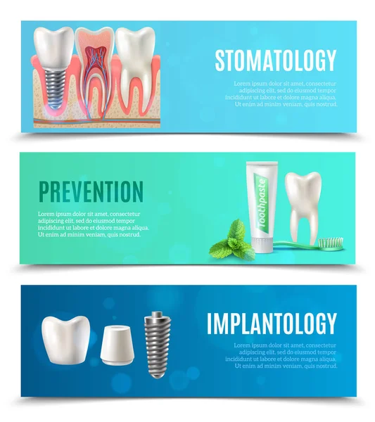 Implantes dentales 3 Set de Banners Horizontales — Vector de stock