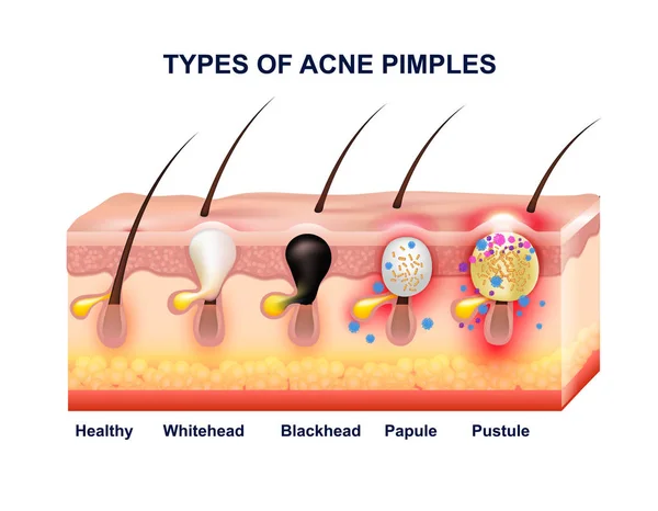 Composizione anatomica dell'acne della pelle — Vettoriale Stock