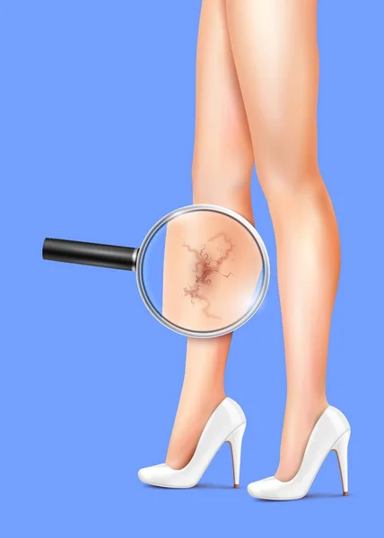 Jambes féminines et illustration réaliste variqueuse — Image vectorielle