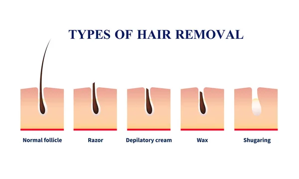 Типи ілюстрацій для видалення волосся — стоковий вектор