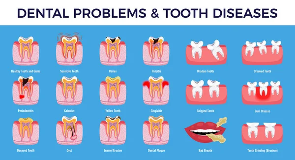 Conjunto Infográfico de Enfermedades de Problemas Dentales — Vector de stock