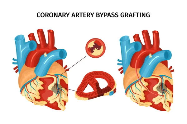 Ilustración de bypass de anatomía cardíaca — Vector de stock