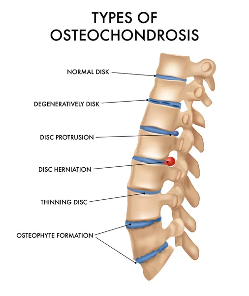 Ryggraden Hernia realistiska diagram — Stock vektor