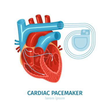 Kalp Pacemaker İllüstrasyonu
