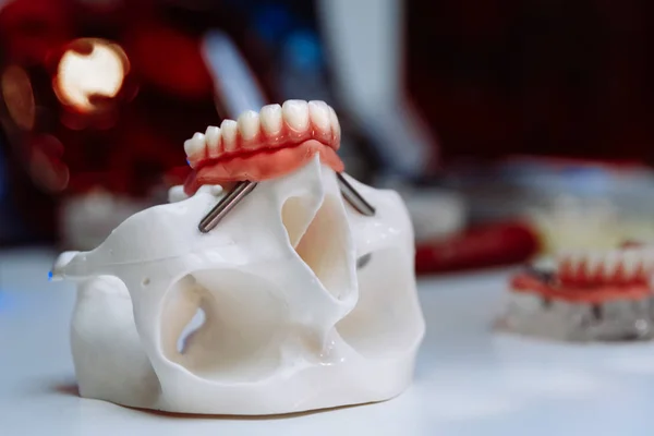 Műanyag modell a koponya fogászati és maxilloarcplasztika. — Stock Fotó