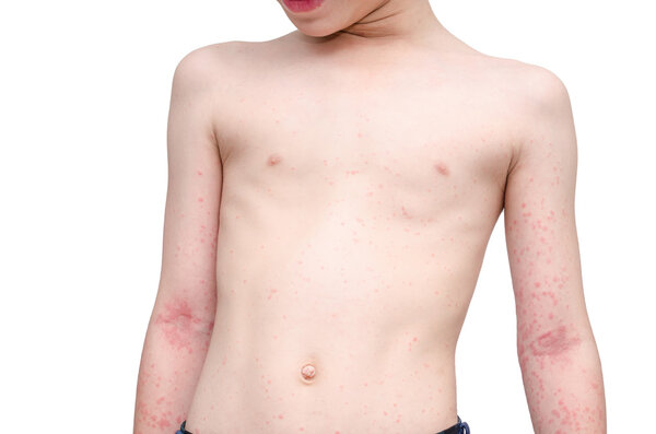 child skin with rash over white 