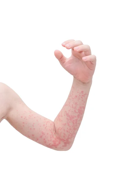 Child arm skin with rash over white — Stock Photo, Image