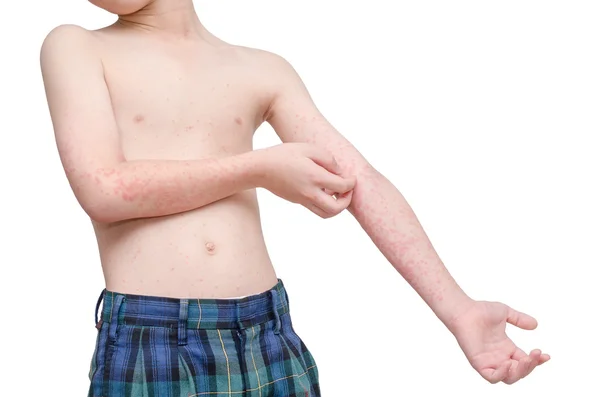 Child screatching skin with rash — Stock Photo, Image