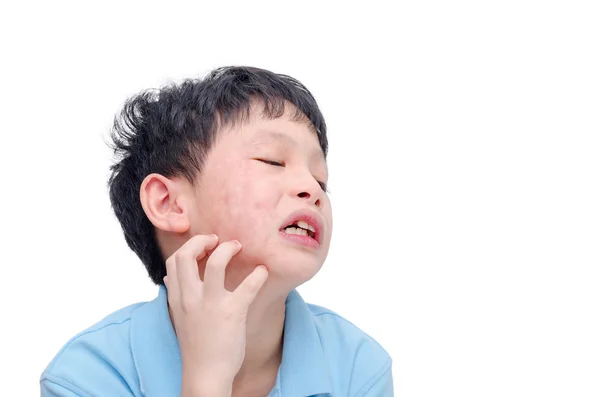 Мальчик царапает лицо аллергии — стоковое фото