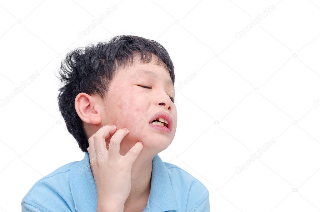 boy scratching his allergy face