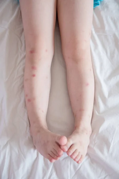 Укуси комарів болять на ногах — стокове фото