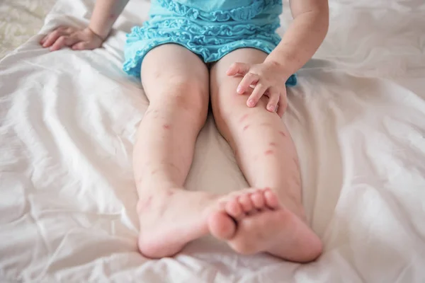 Mückenstiche wund an den Beinen — Stockfoto