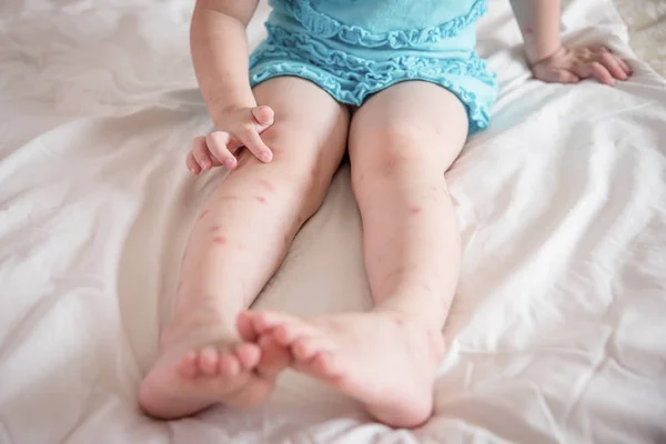 Morsi di zanzara dolorante sulle gambe — Foto Stock