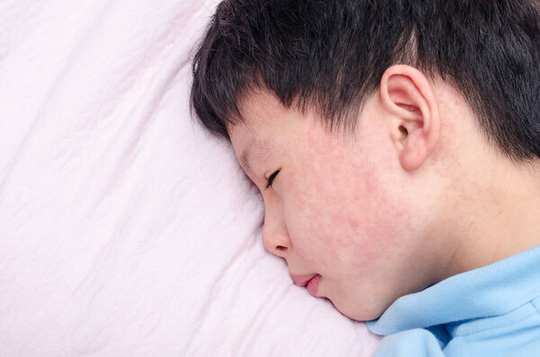 child face with rash lying on bed