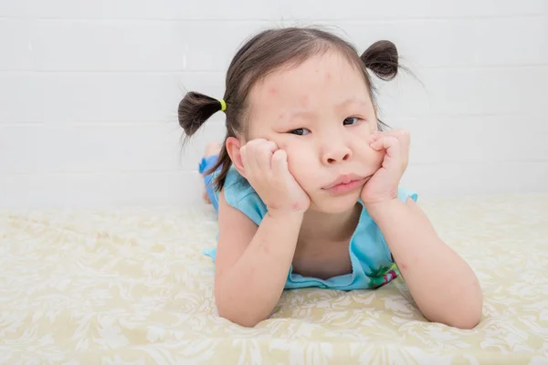 Little Asian Girl Red Spot Mosquito Bite Face — Stock Photo, Image