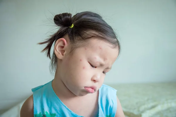 Chica se siente triste por mancha en su cara de insectos picadura —  Fotos de Stock