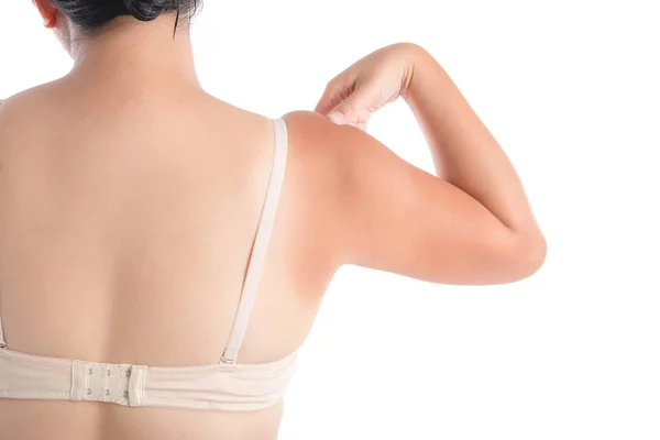 Back of woman with sunburn over white — Stock Photo, Image