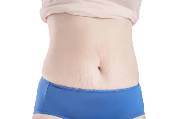 Mulher barriga pele com estrias marca cicatriz sobre branco — Fotografia de Stock