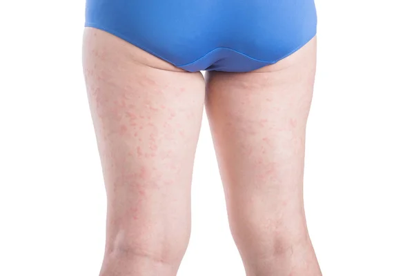 Face arrière de la jambe de la femme avec éruption allergique sur blanc — Photo