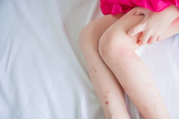 Ноги з набряком плями від укусу комарів — стокове фото