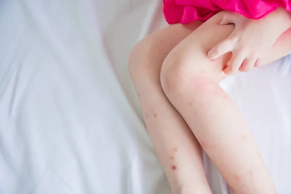 Legs with swelling spot from mosquitoes bite — Stock Photo, Image