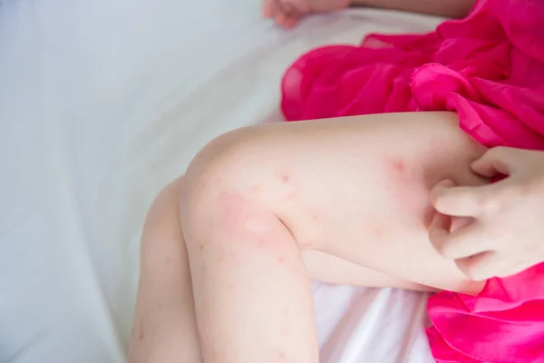 Legs with swelling spot from mosquitoes bite — Stock Photo, Image