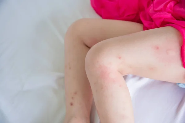 Legs of little girl with swelling spot — Stock Photo, Image