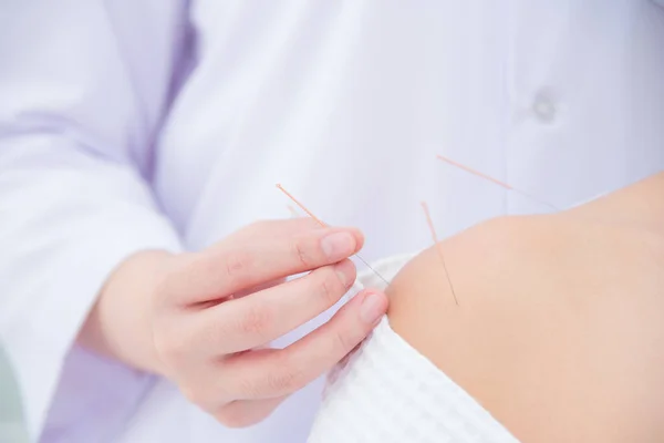 Primer plano de las manos haciendo acupuntura con en el hombro del paciente — Foto de Stock