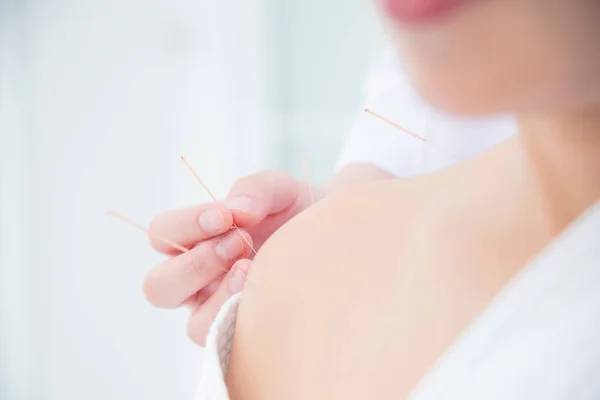 Close up de mãos fazendo acupuntura com no ombro do paciente — Fotografia de Stock