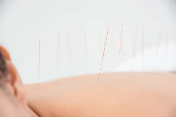Zbliżenie igły na plecach kobiety poddanej akupunkturze w klinice — Zdjęcie stockowe
