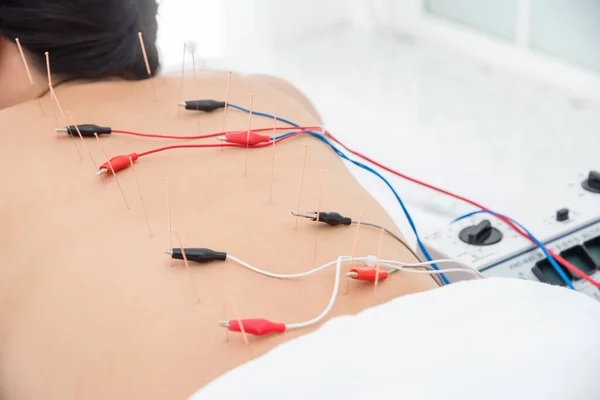 Mujer asiática recibiendo acupuntura con estimulador eléctrico en la espalda —  Fotos de Stock