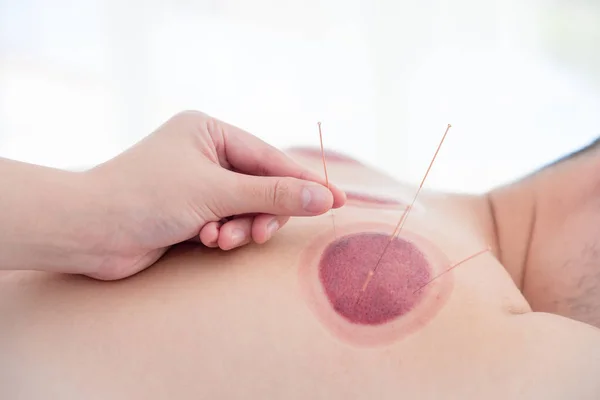 Closeup acupuncturist inserting needle on patient back — Stock Photo, Image