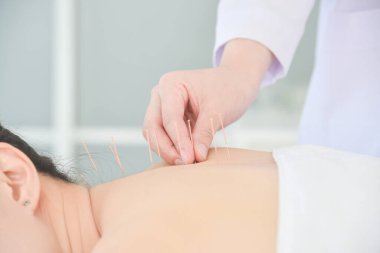 Alternatif tıp konsepti olan hastaya akupunktur yapan terapistin elleri.