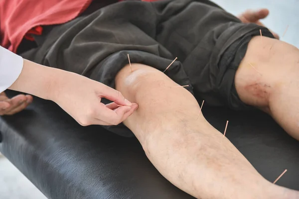 Egy Férfi Kap Akupunktúra Térd Lábak Enyhítésére Fájdalom Alternatív Gyógyászat — Stock Fotó