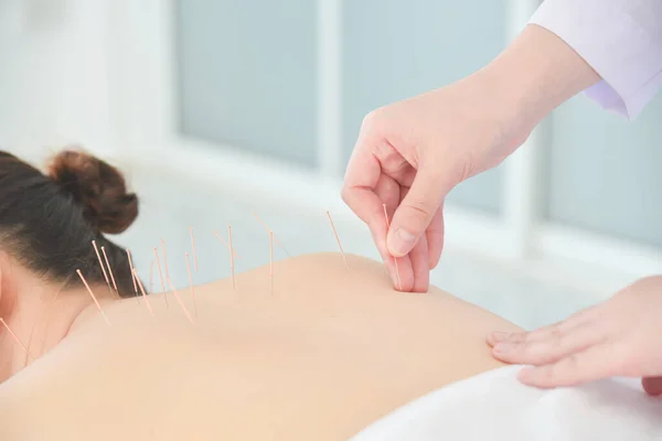 Manos Del Terapeuta Haciendo Acupuntura Espalda Del Paciente Concepto Medicina —  Fotos de Stock