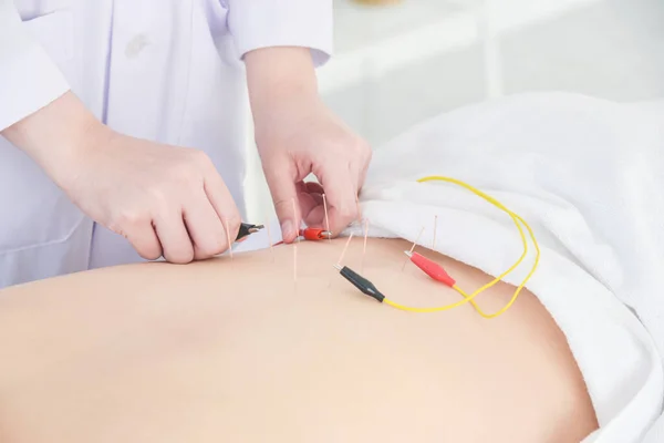 Gros Plan Acupuncteur Mains Faisant Acupuncture Avec Stimulateur Électrique Dos — Photo