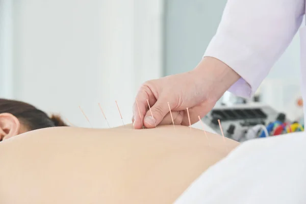 Nahaufnahme Der Hände Bei Der Akupunktur Rücken Des Patienten Alternativmedizinisches — Stockfoto