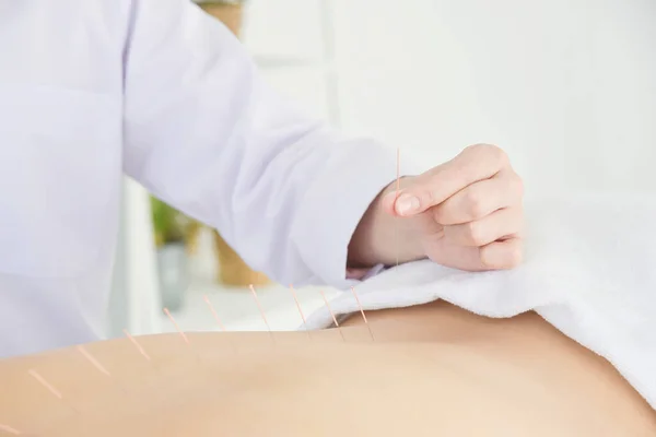 Close Mãos Fazendo Acupuntura Com Parte Trás Paciente Conceito Medicina — Fotografia de Stock