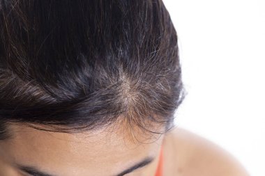 Yakından bakınca, beyaz sırtındaki beyaz saç köklerini gösteriyor.