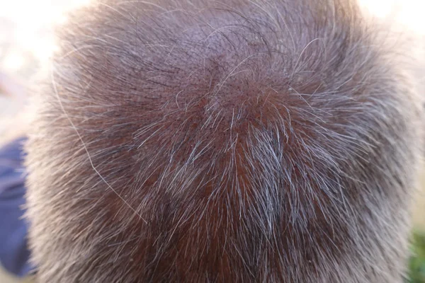 Cabeza de hombre pierde el pelo, glabro en su cabeza para ma edad avanzada — Foto de Stock