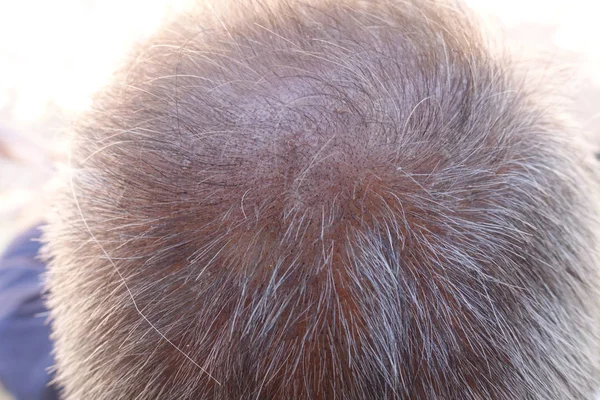 Cabeza de hombre pierde el pelo, glabro en su cabeza para ma edad avanzada — Foto de Stock