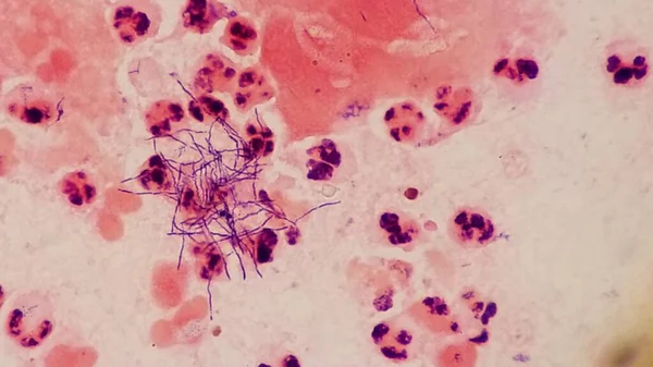 Organismi di Nocardia sulle macchie di Gram con globuli bianchi — Foto Stock