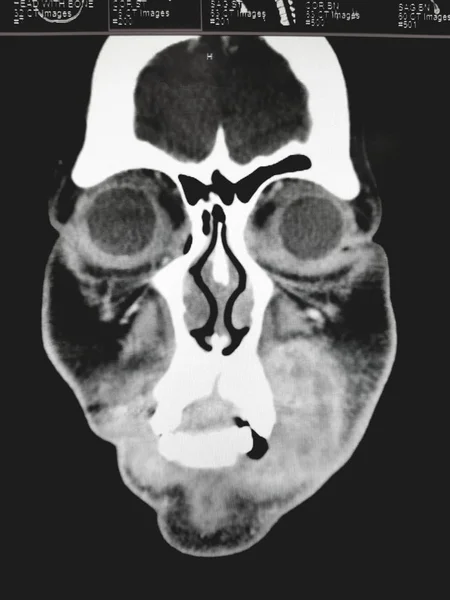 鼻窦和面部冠状CT扫描 — 图库照片