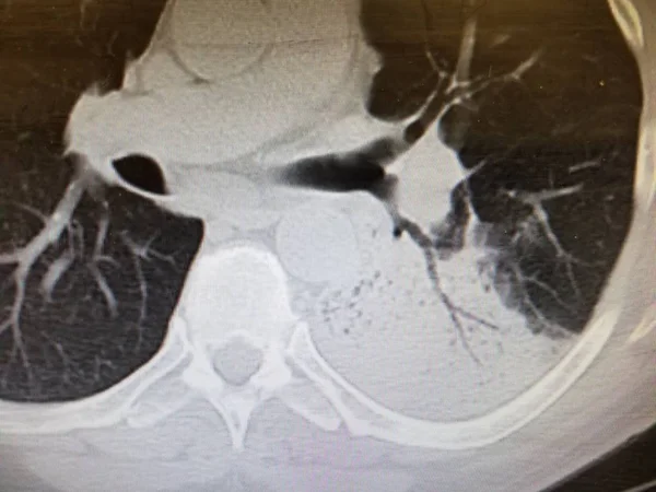 Pneumonia do lobo inferior esquerdo com broncogramas aéreos — Fotografia de Stock